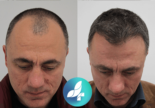 before-after1