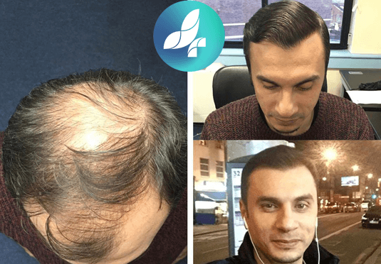 before-after2