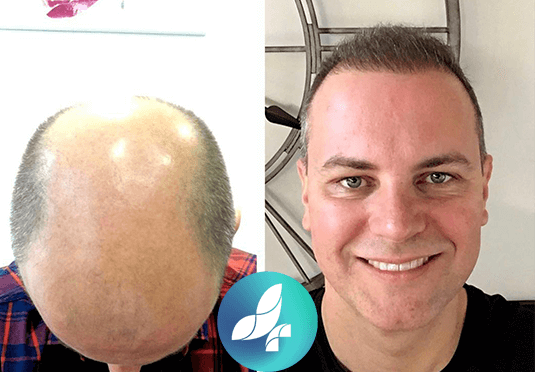 before-after3