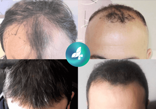 before-after5