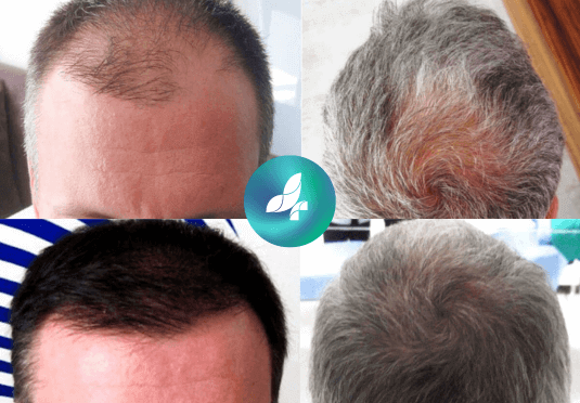 before-after6