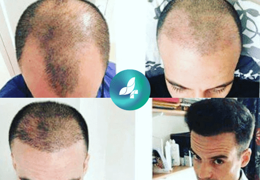 before-after7