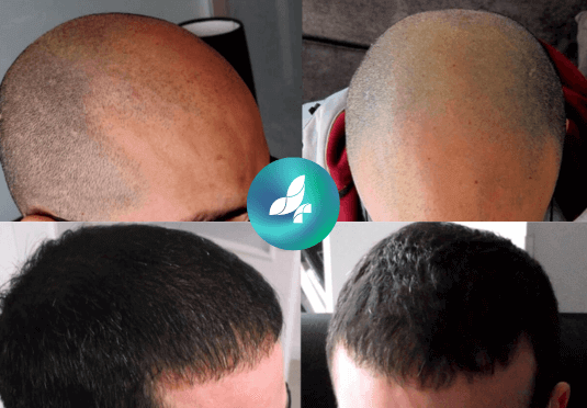 before-after8